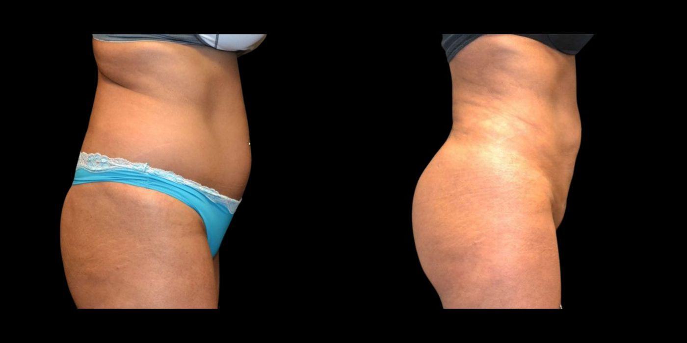 Before and after procedure result