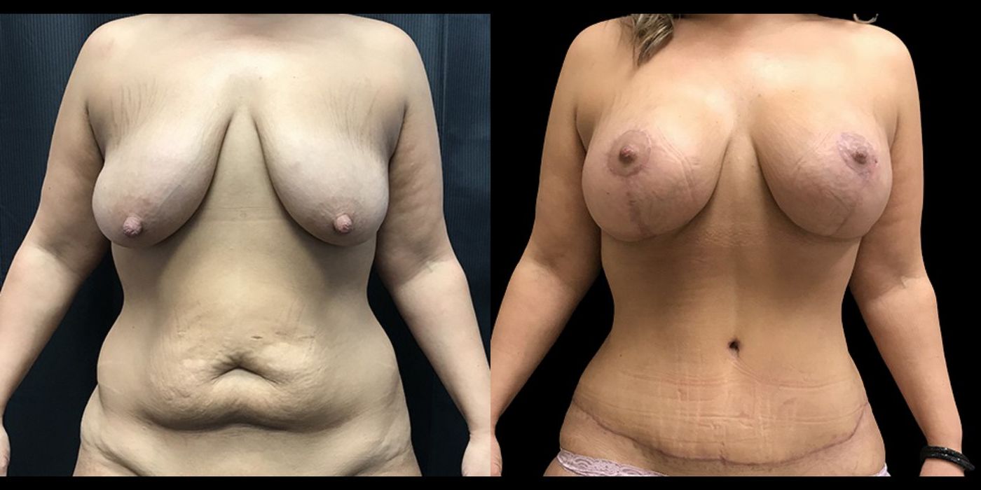 Before and after procedure result