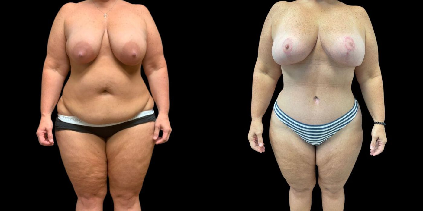 Before and after procedure result