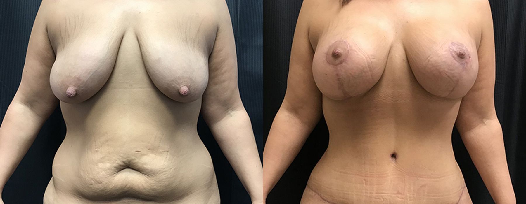 Before and after procedure result