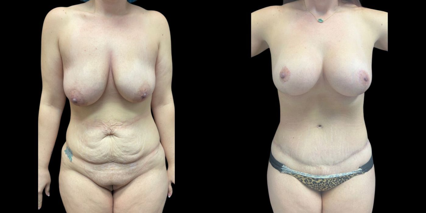 Before and after procedure result