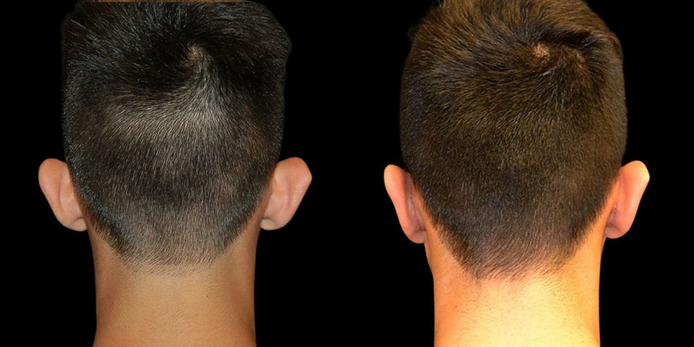 Before and after procedure result