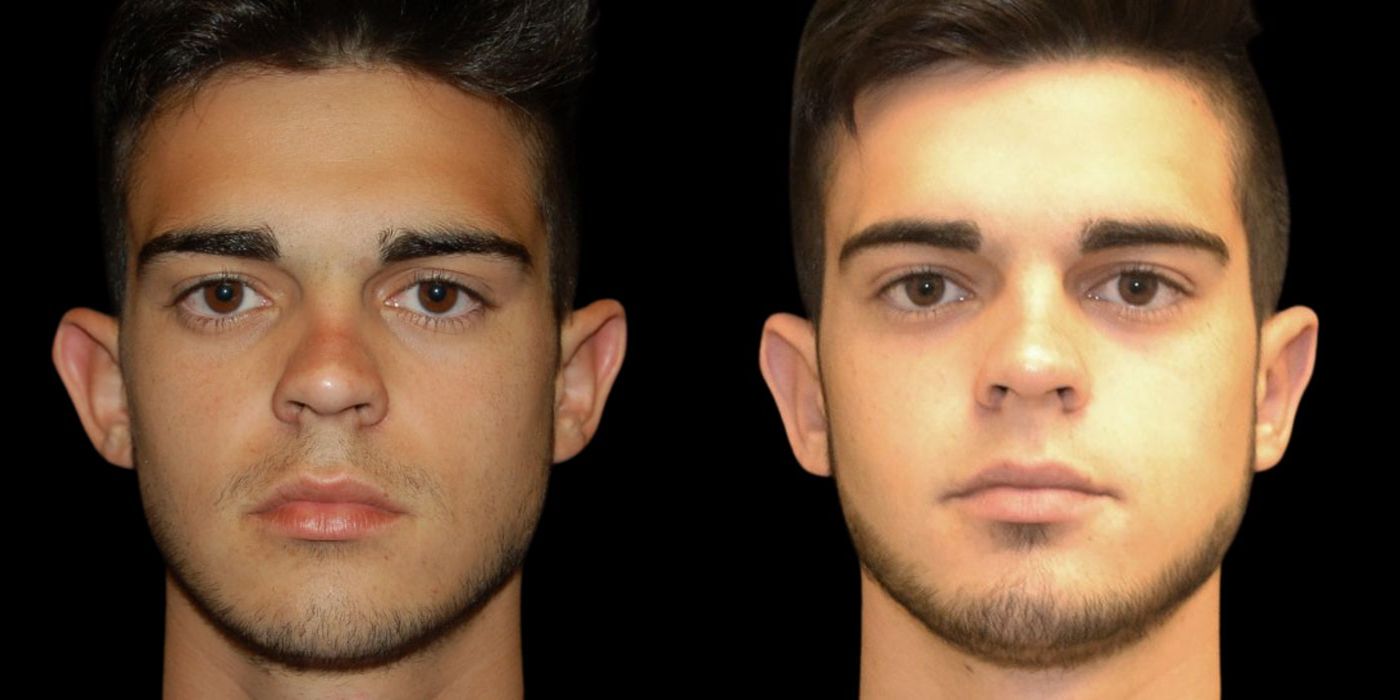 Before and after procedure result