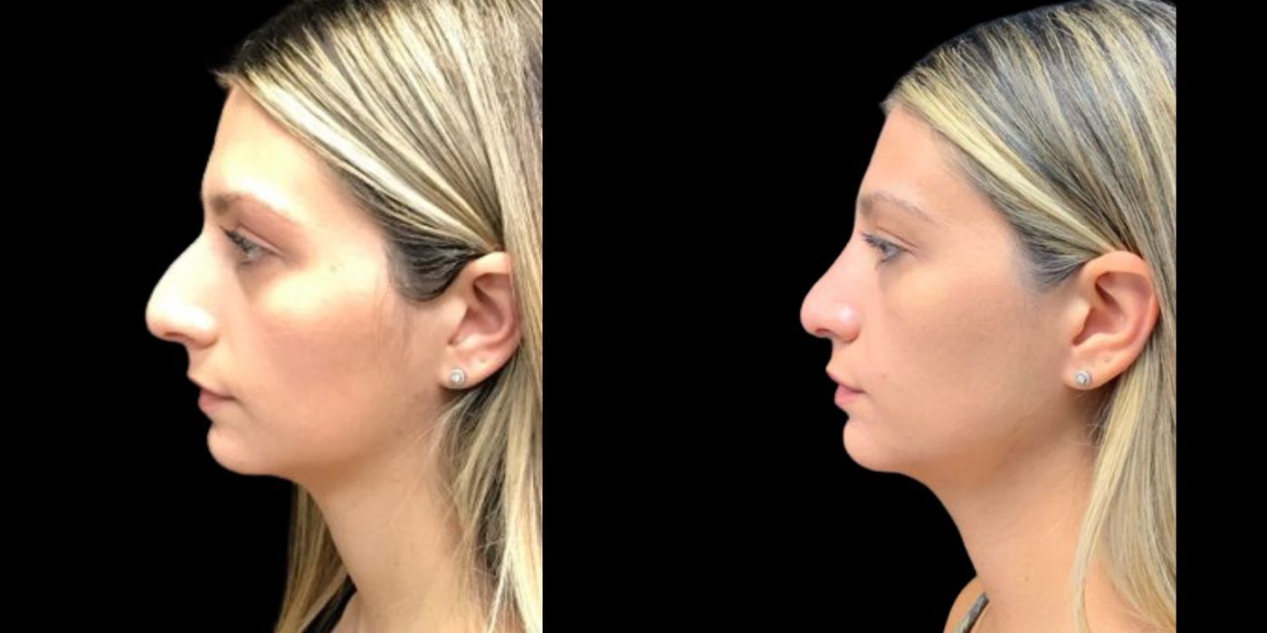 Before and after procedure result