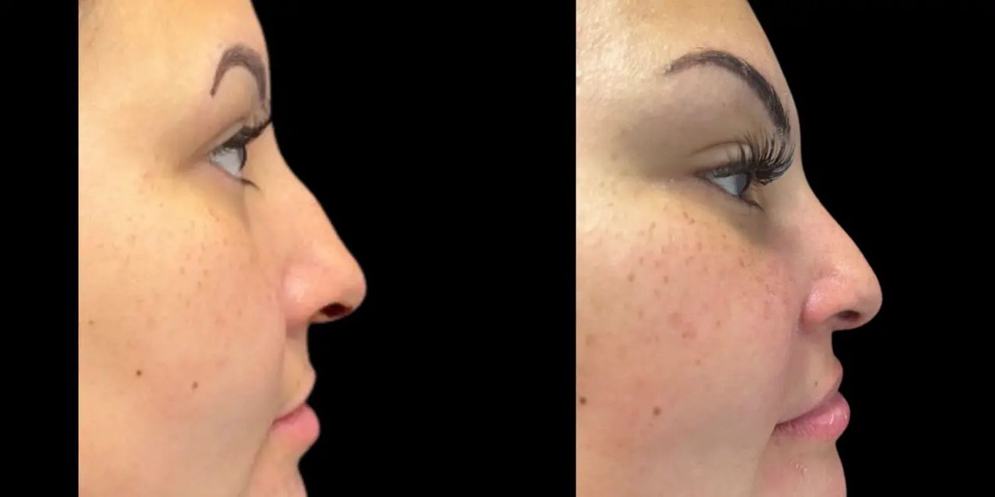 Before and after procedure result