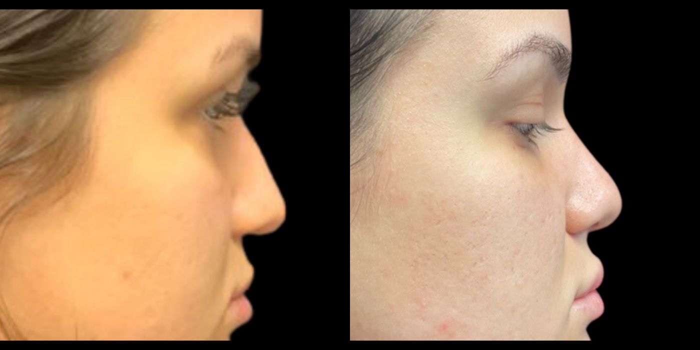 Before and after procedure result