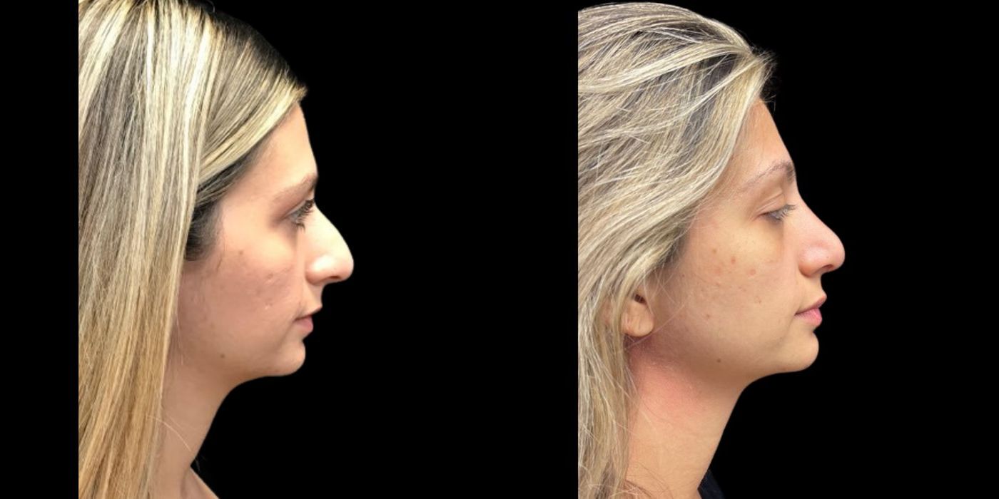 Before and after procedure result