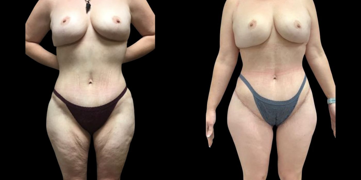 Before and after procedure result