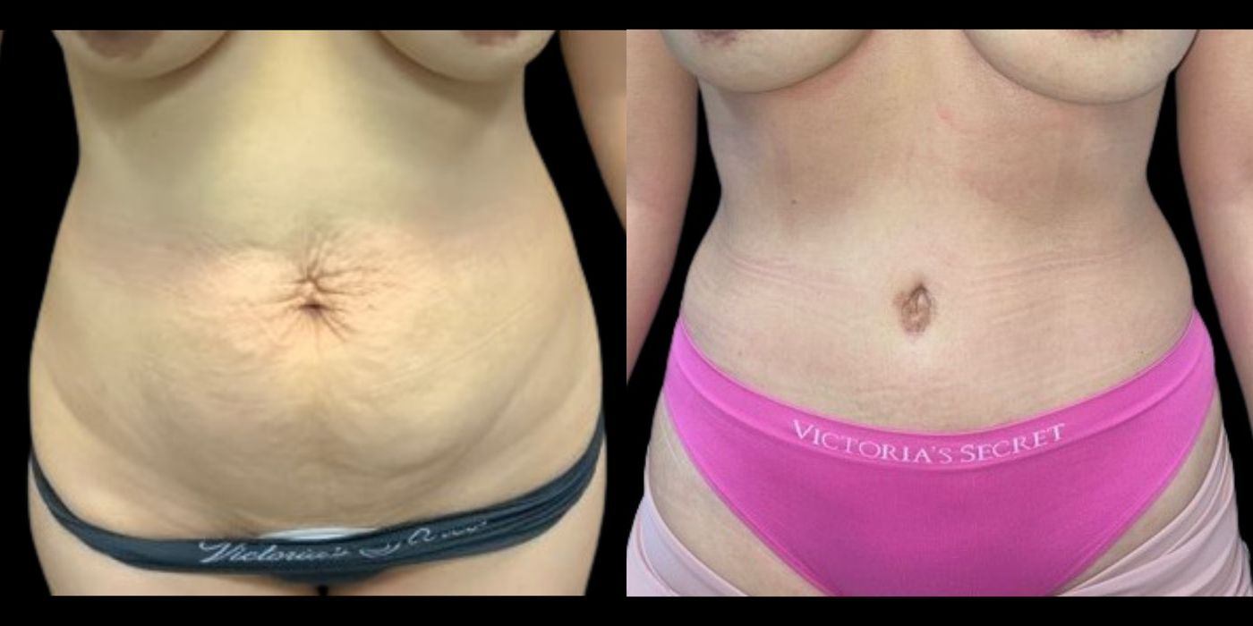 Tummy Tuck - Case 240711