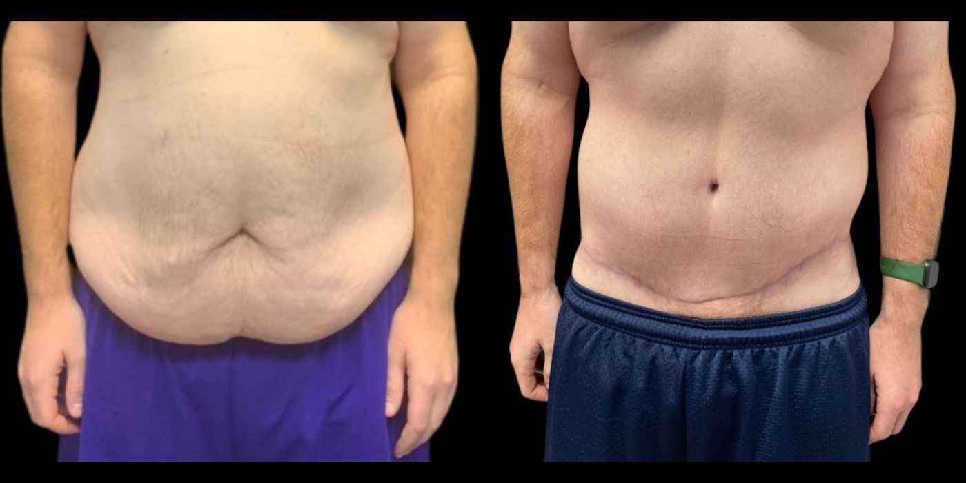 Before and after procedure result