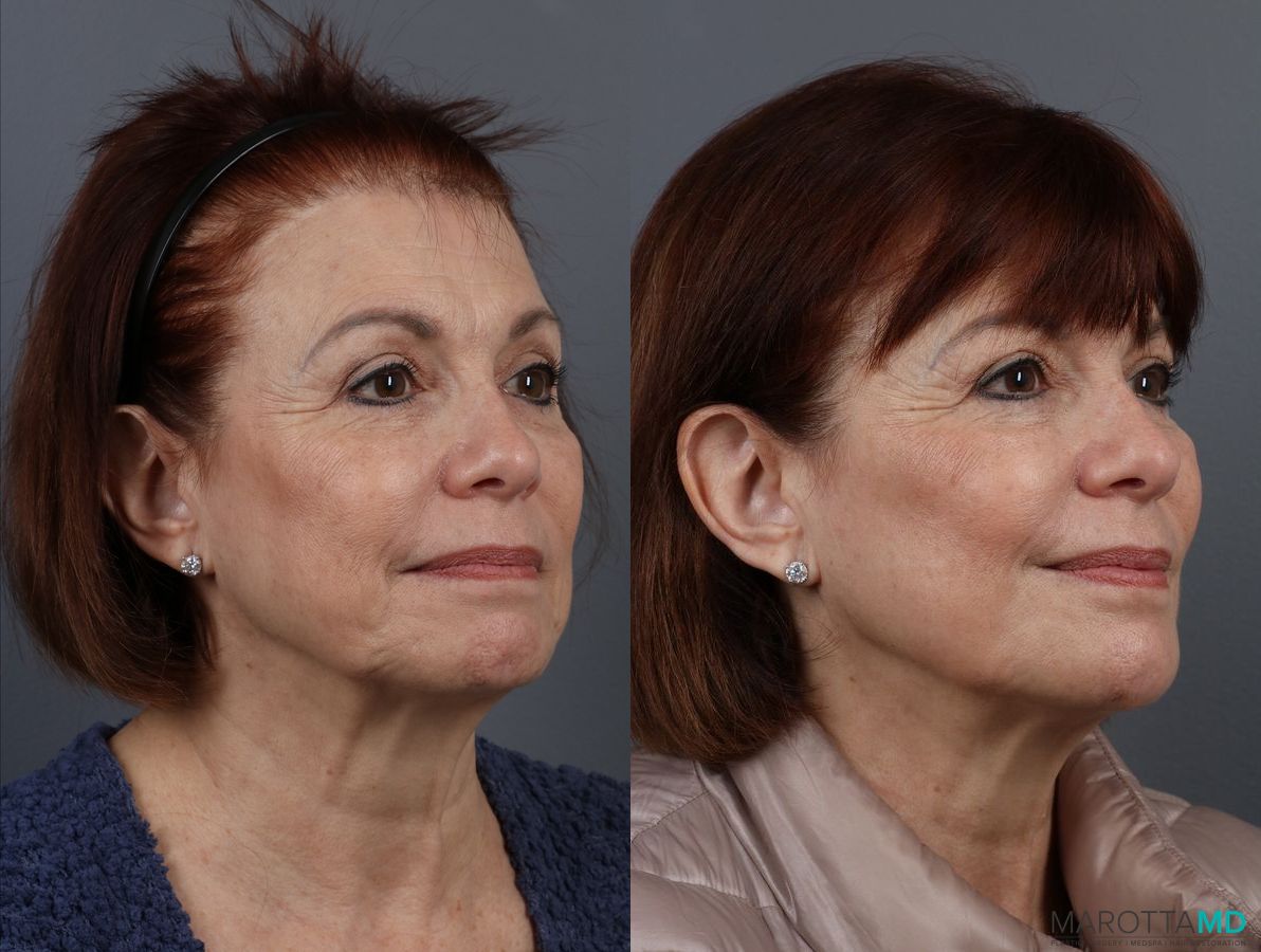 Before and after BOTOX® Cosmetic case 7314 - Angle 3