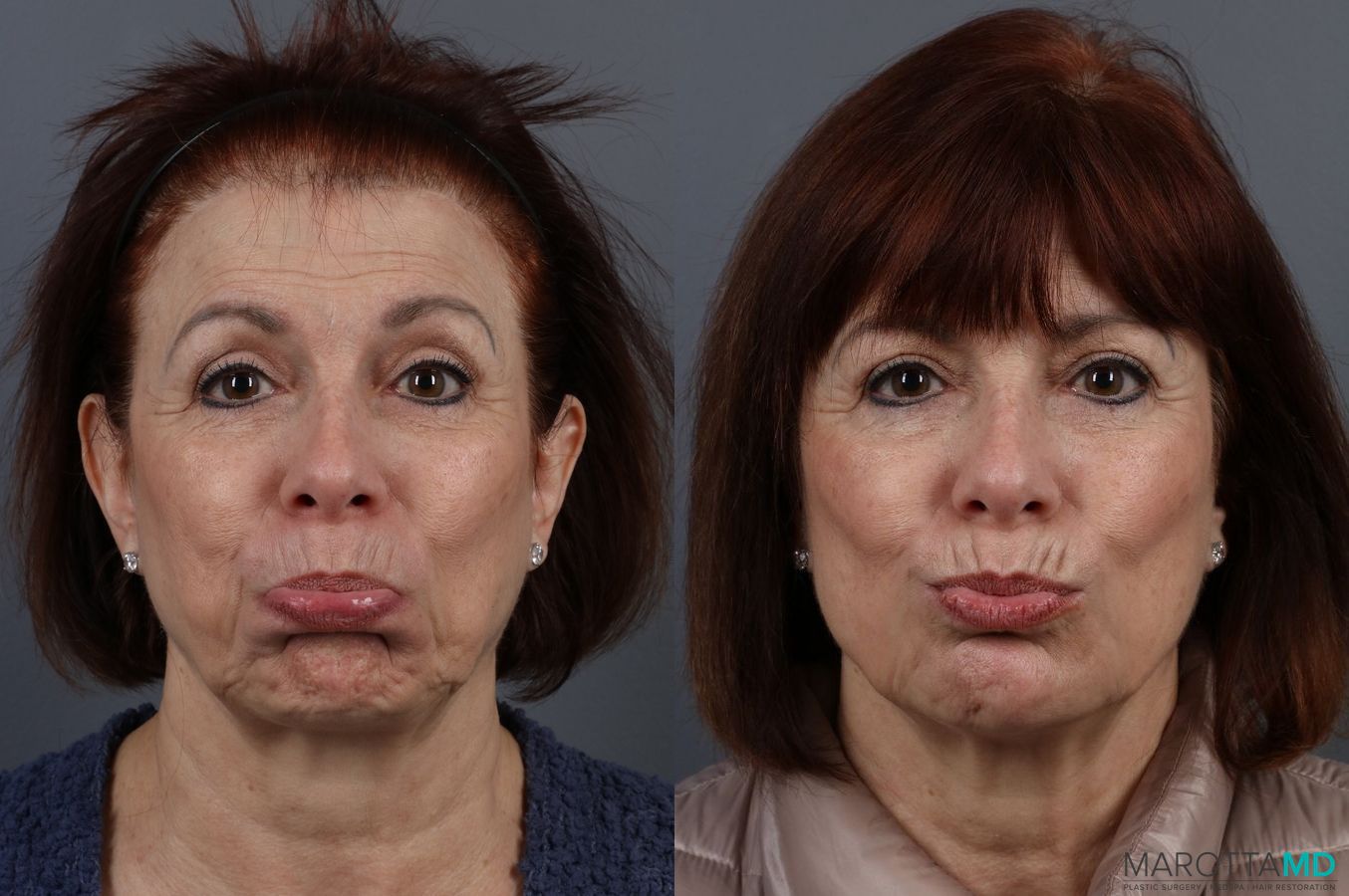 Before and after BOTOX® Cosmetic case 7314 - Angle 2