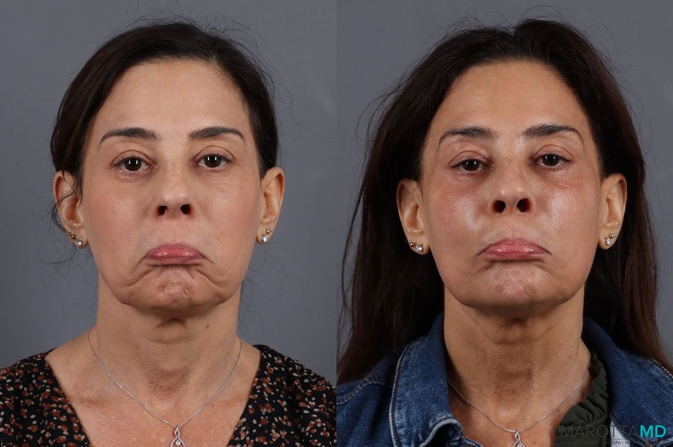 Before and after BOTOX® Cosmetic case 7267 - Angle 2