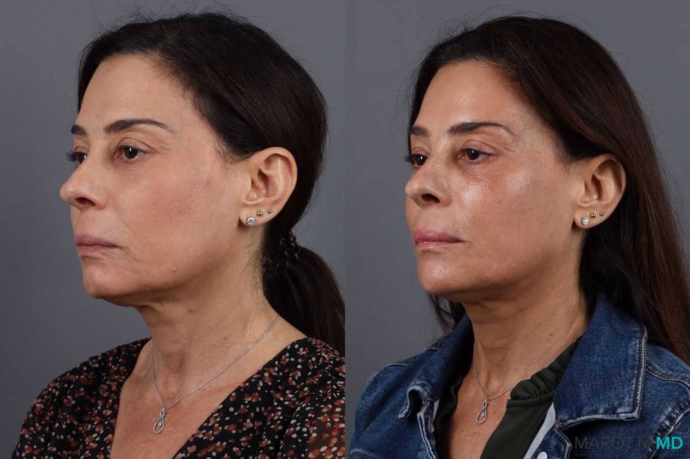 Before and after BOTOX® Cosmetic case 7267 - Angle 3
