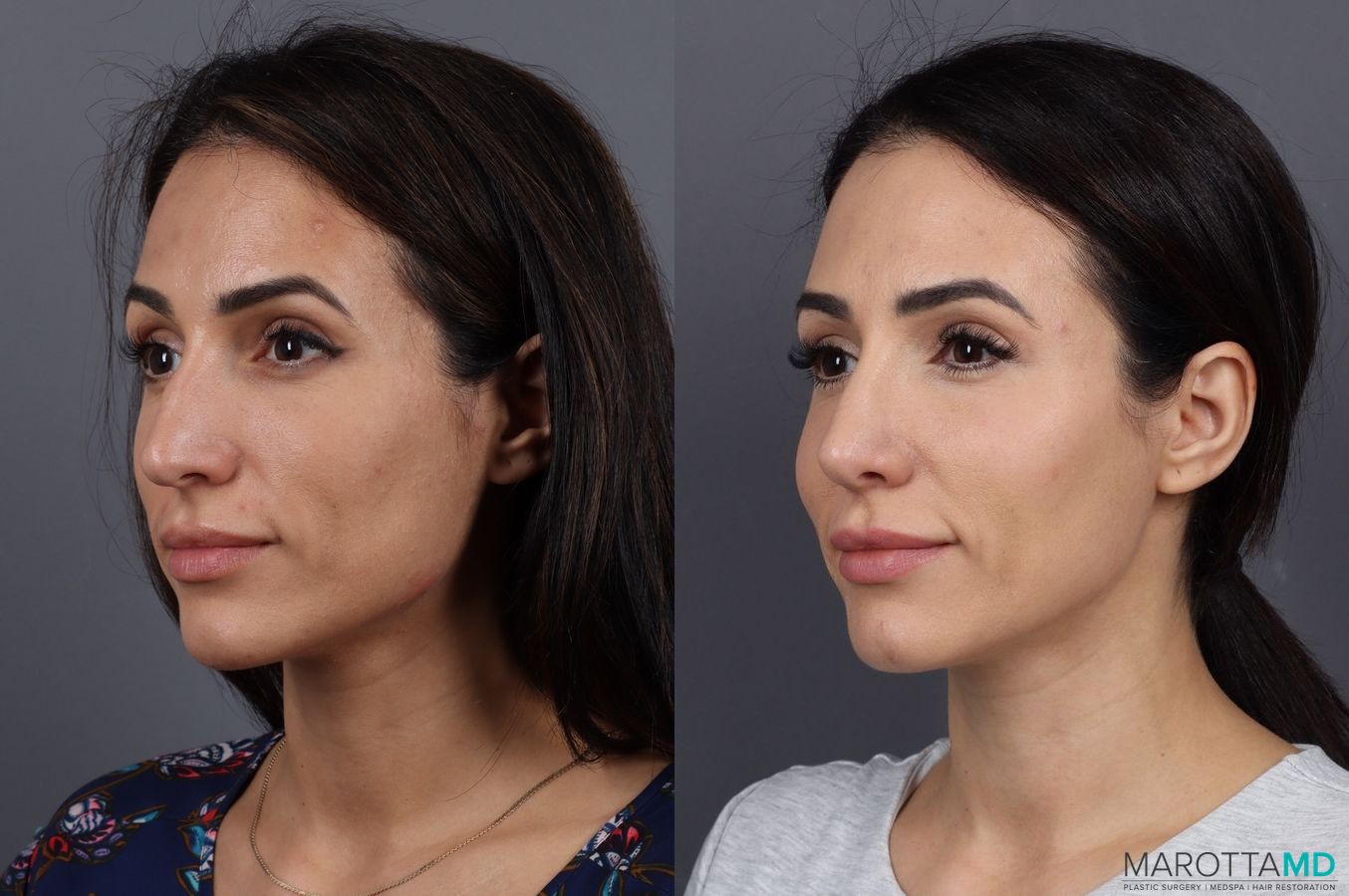 Before and after BOTOX® Cosmetic case 7298 - Angle 4