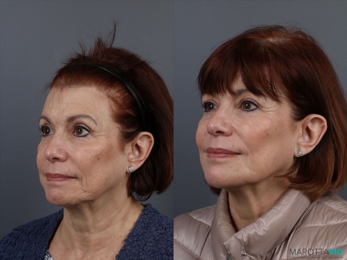 Before and after BOTOX® Cosmetic case 7314 - Angle 5