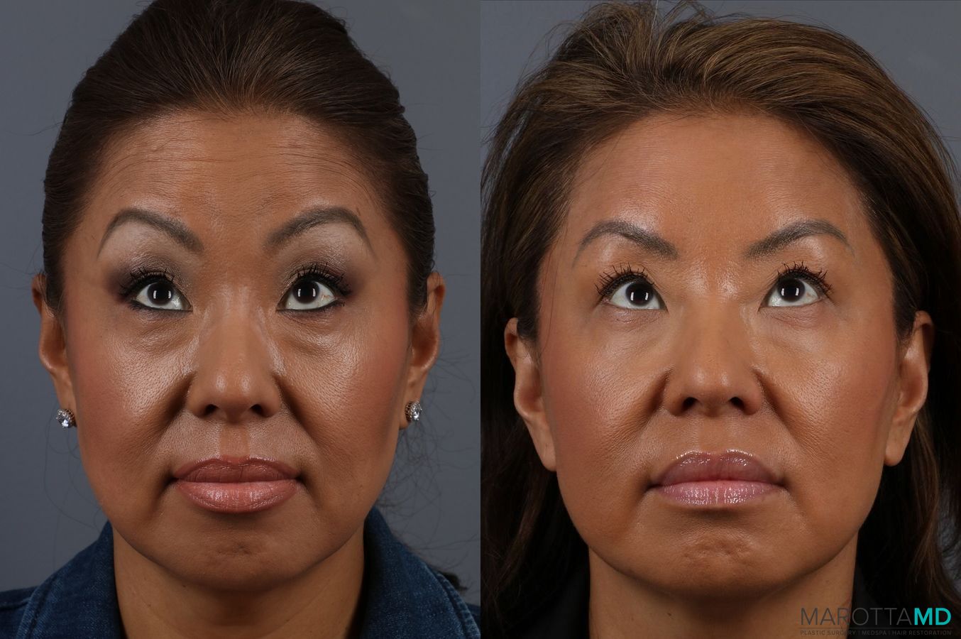 Before and after BOTOX® Cosmetic case 7318 - Angle 4