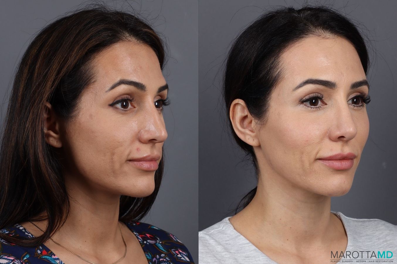 Before and after BOTOX® Cosmetic case 7298 - Angle 2