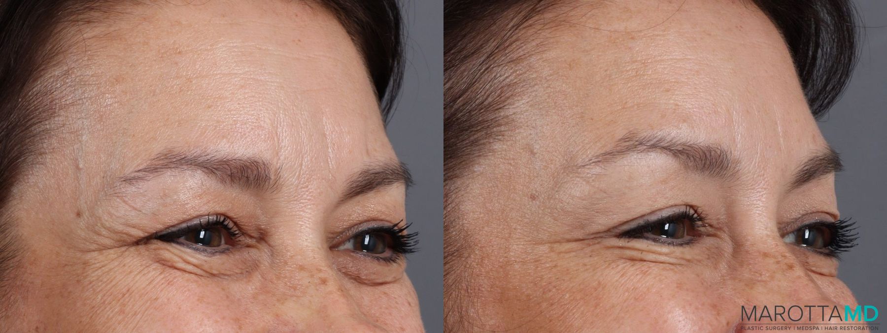 Before and after BOTOX® Cosmetic case 7240 - Angle 3