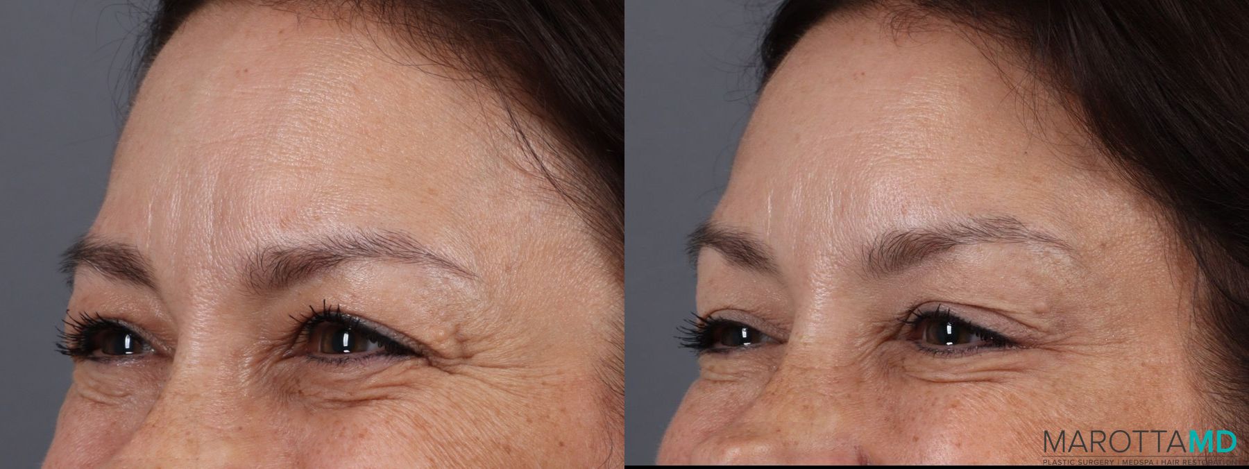 Before and after BOTOX® Cosmetic case 7240 - Angle 4