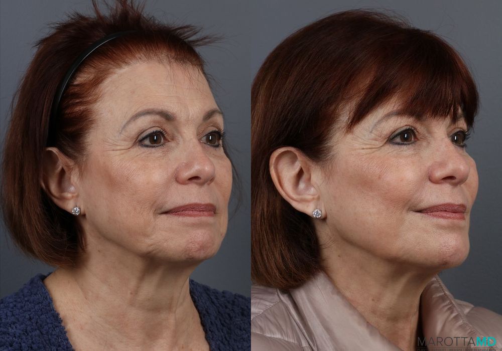 BOTOX® Cosmetic - Thumbnail 3