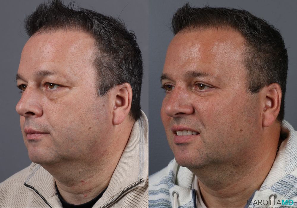 Blepharoplasty - Case 156