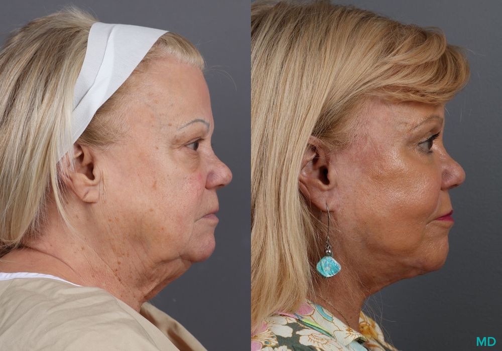 Before and after Blepharoplasty case 7127 - Angle 3