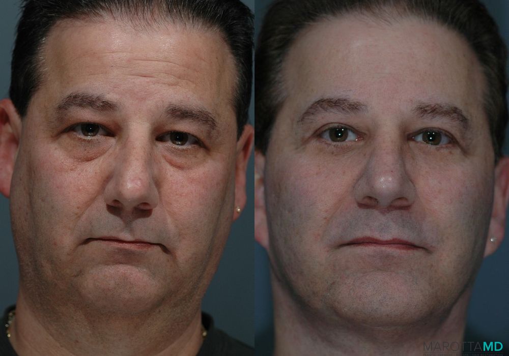 Blepharoplasty - Case 155