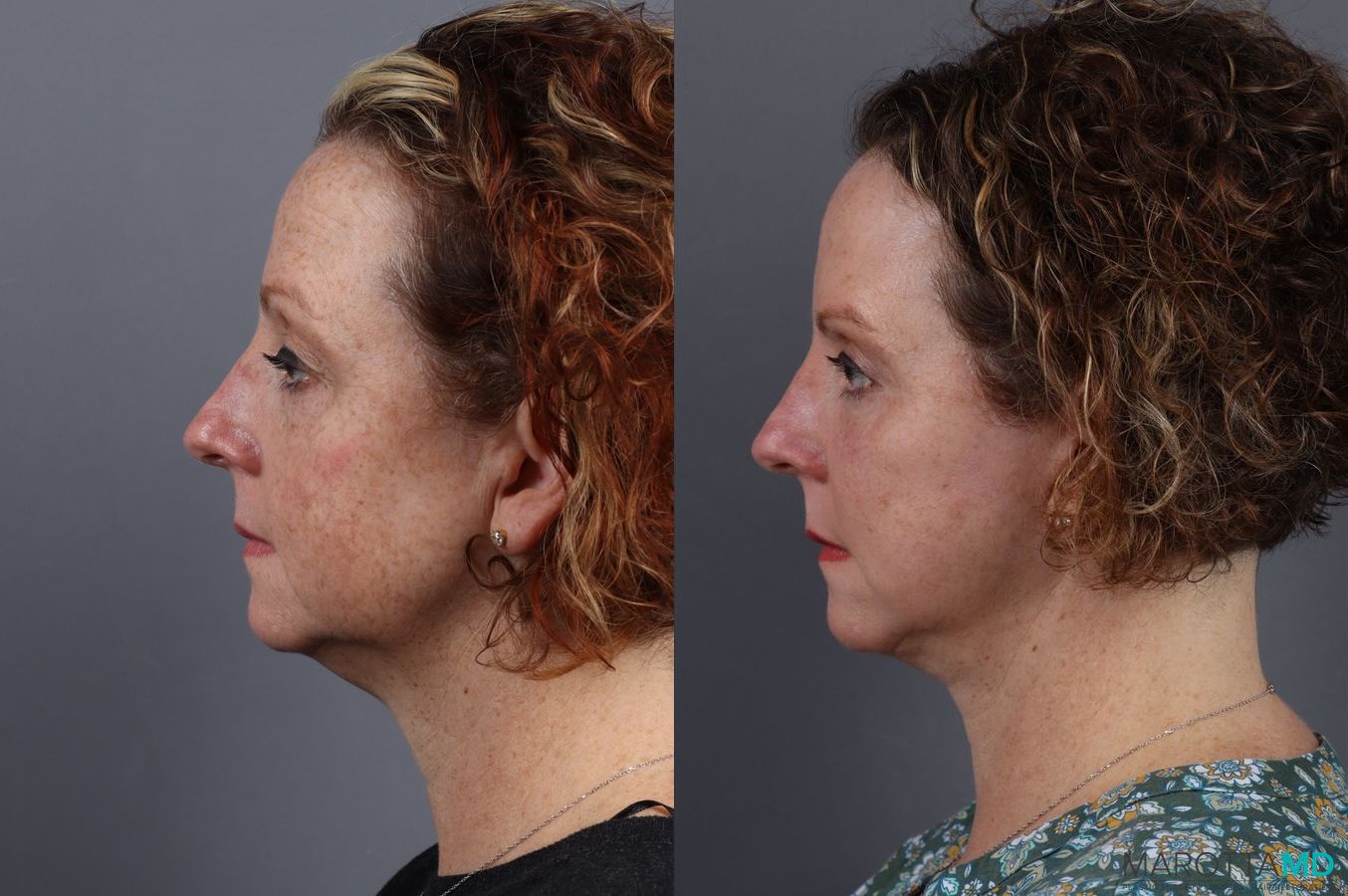 Before and after Blepharoplasty case 7084 - Angle 3
