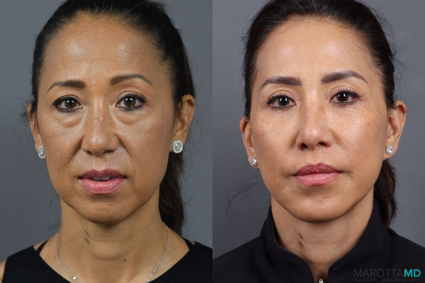 Before and after Blepharoplasty case 7025