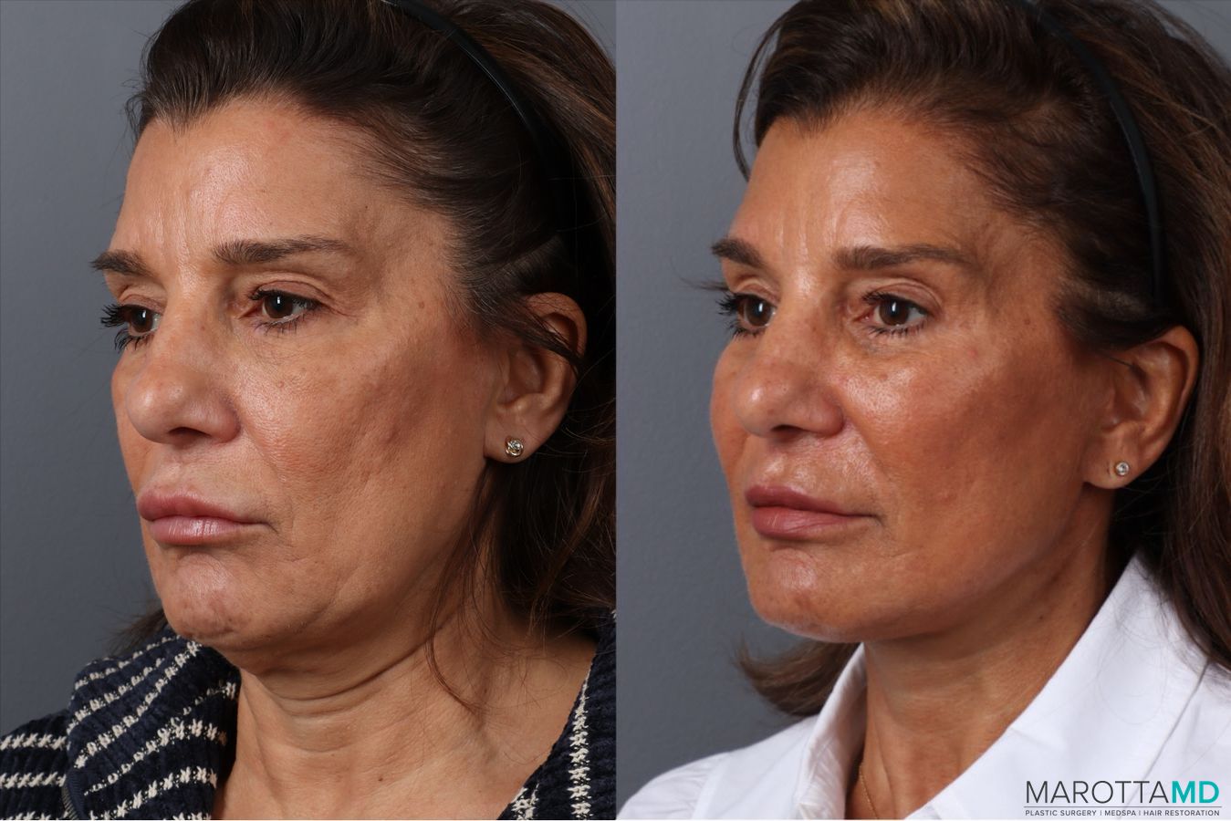 Before and after Facelift & Neck Lift case 49878