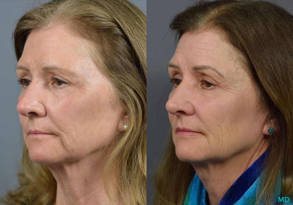 Before and after Blepharoplasty case 7082 - Angle 3