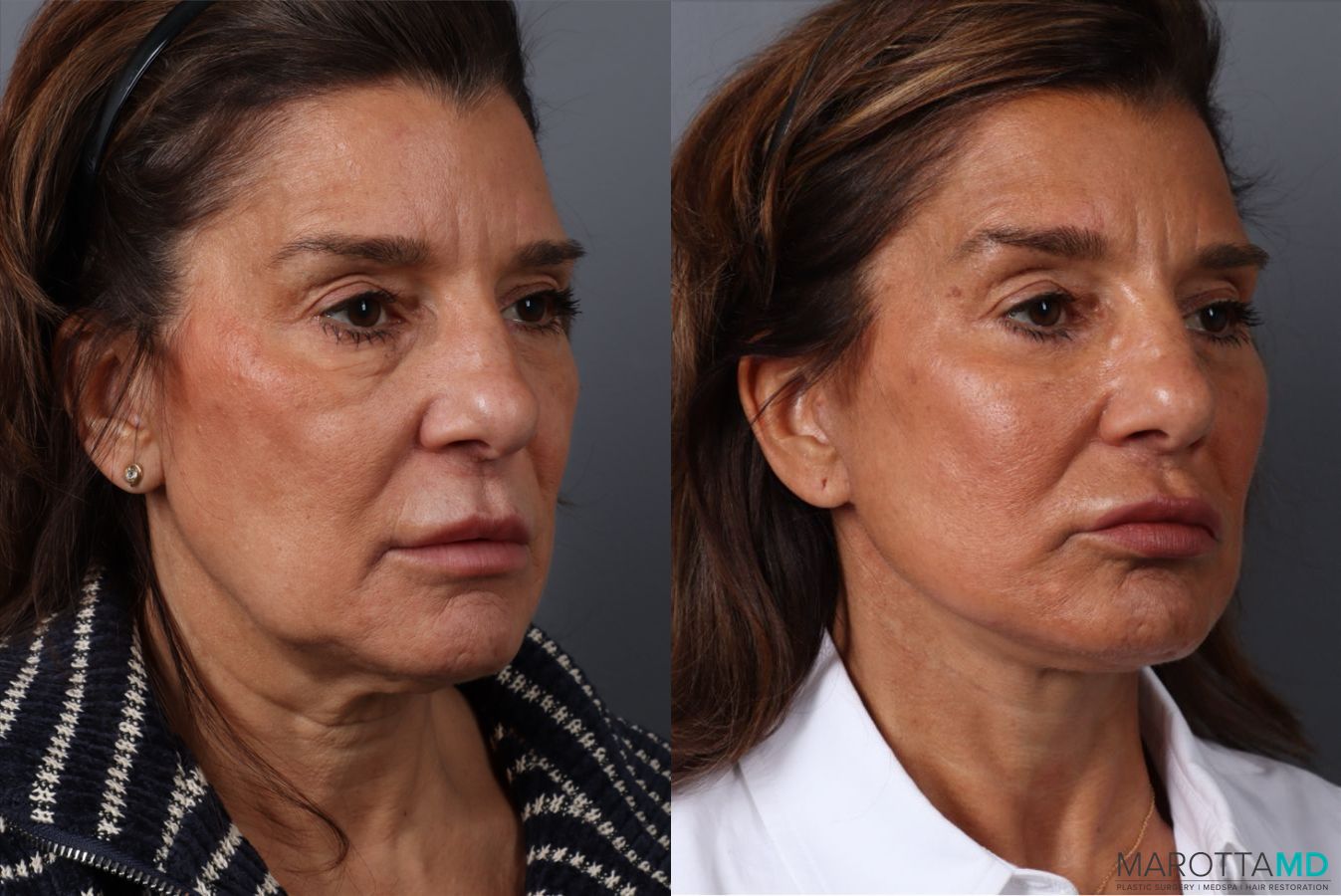 Before and after Facelift & Neck Lift case 49878 - Angle 4