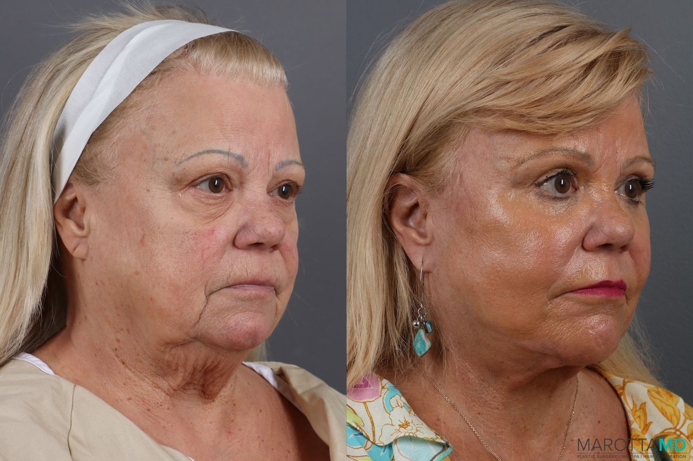Before and after Blepharoplasty case 7127 - Angle 2