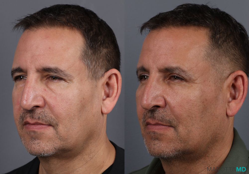 Blepharoplasty - Thumbnail 3