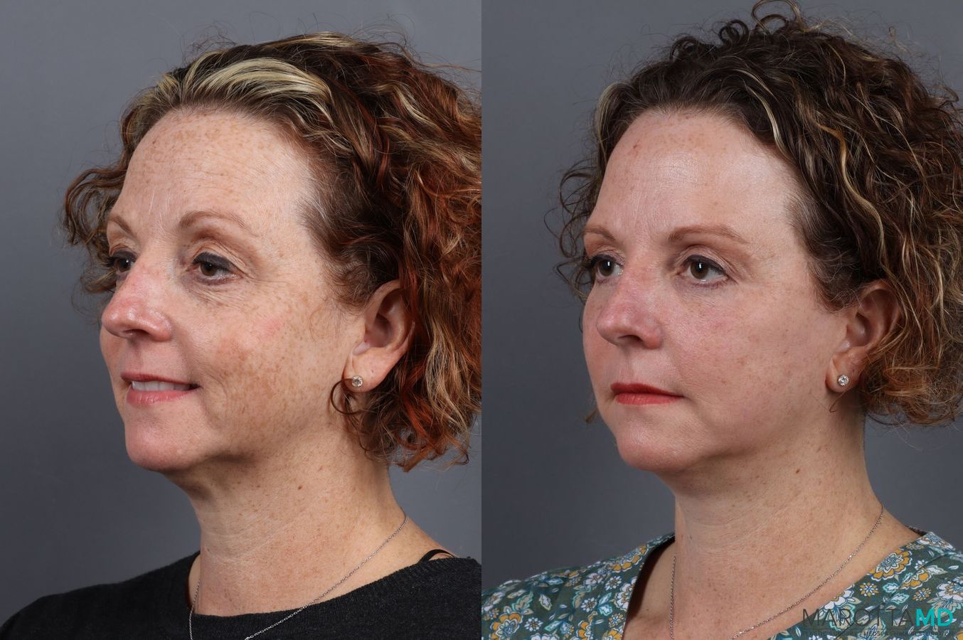 Before and after Blepharoplasty case 7084 - Angle 2