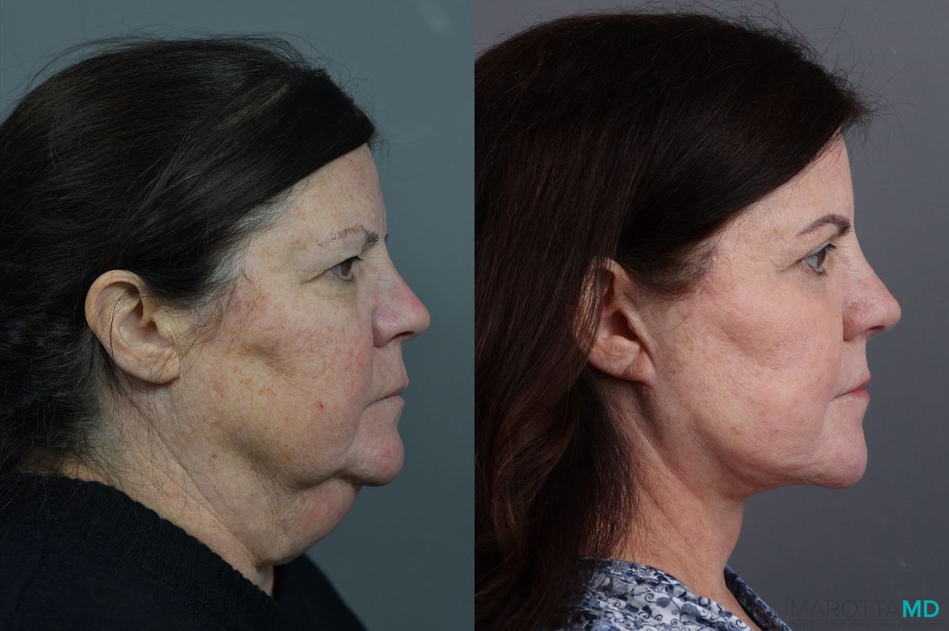 Before and after Blepharoplasty case 7078 - Angle 3