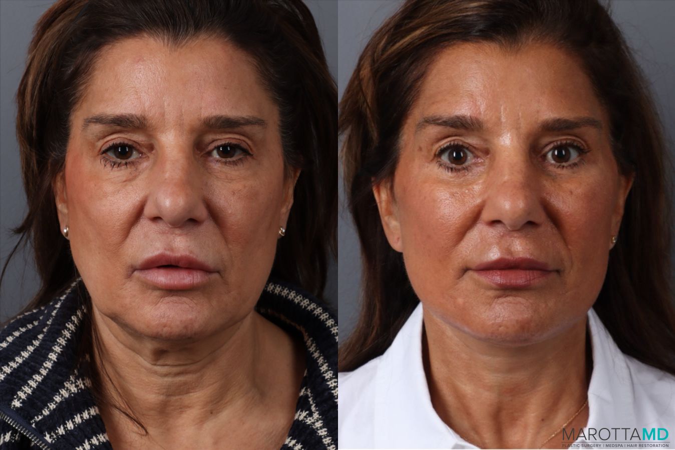 Before and after Blepharoplasty Lower case 49878 - Angle 3
