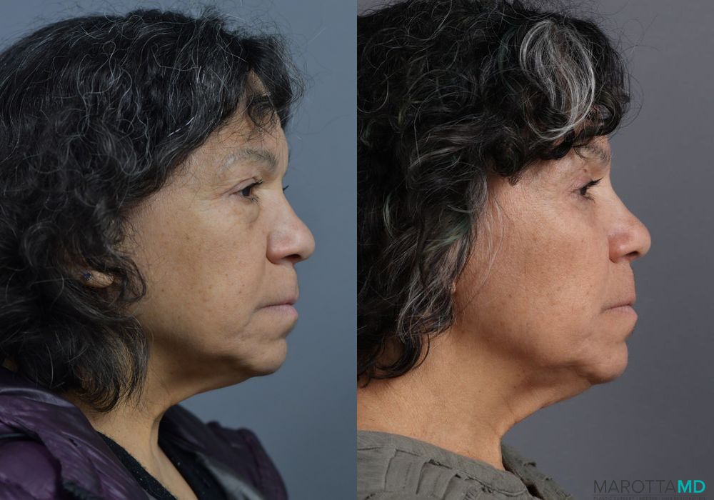 Blepharoplasty - Thumbnail 5