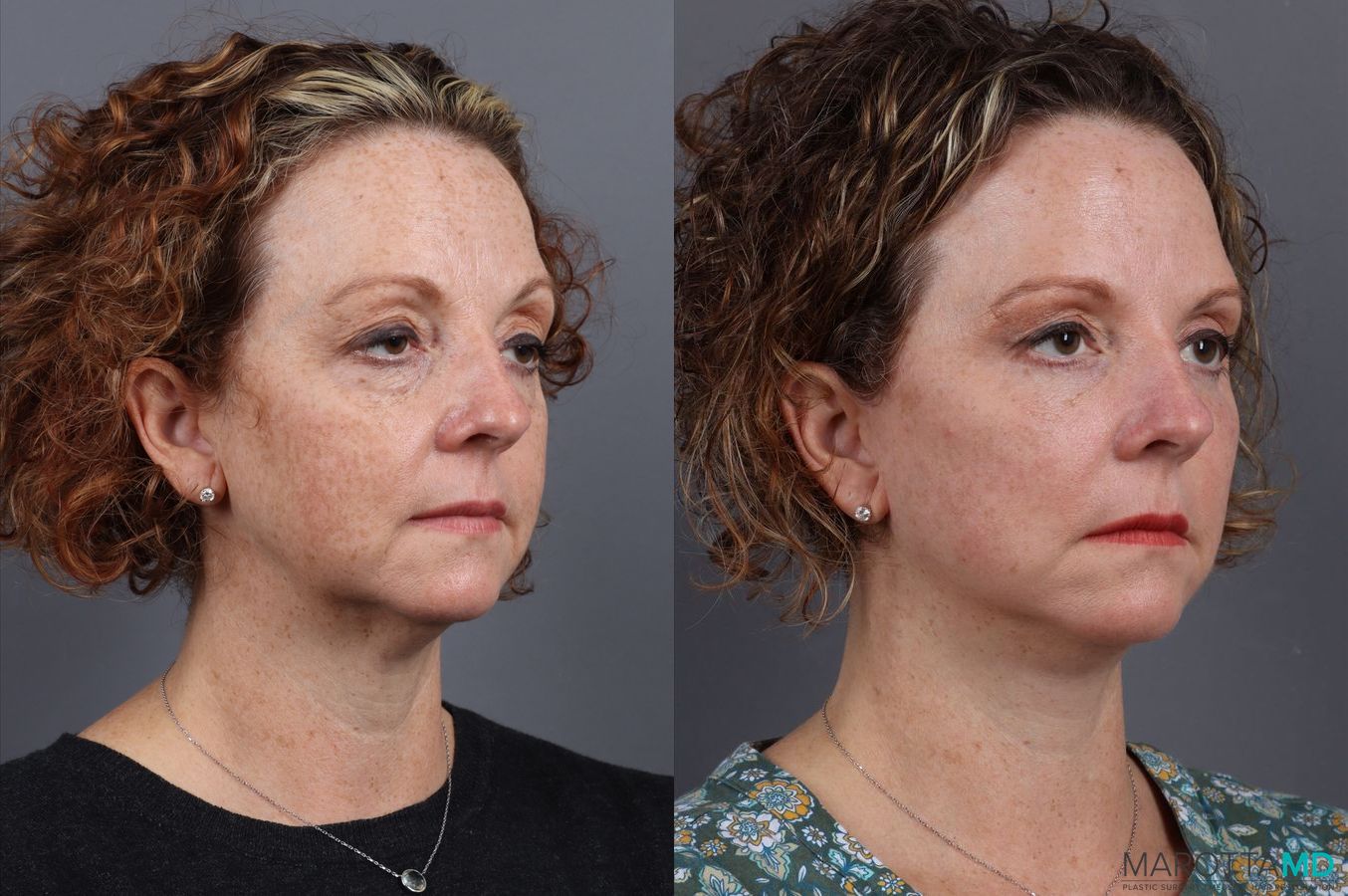 Before and after Blepharoplasty case 7084 - Angle 4