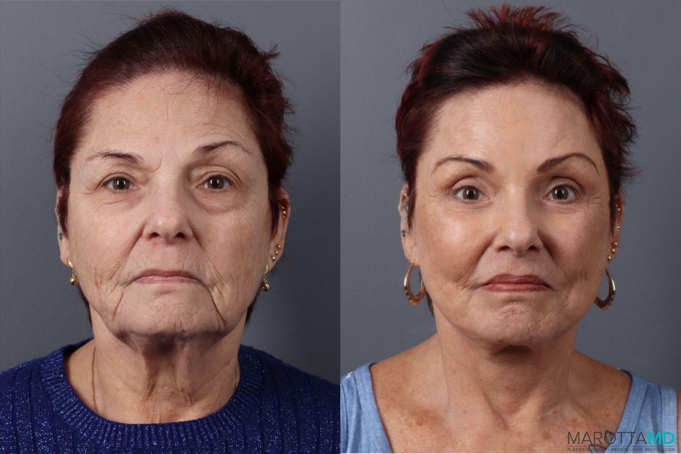Before and after Blepharoplasty Lower case 49464
