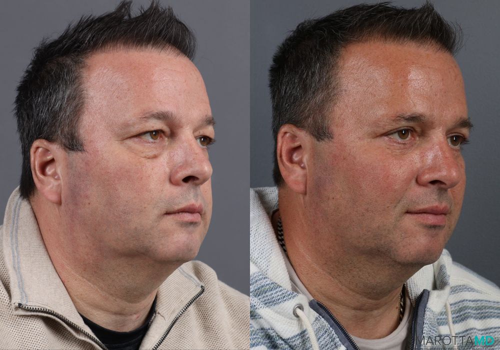 Blepharoplasty - Thumbnail 3