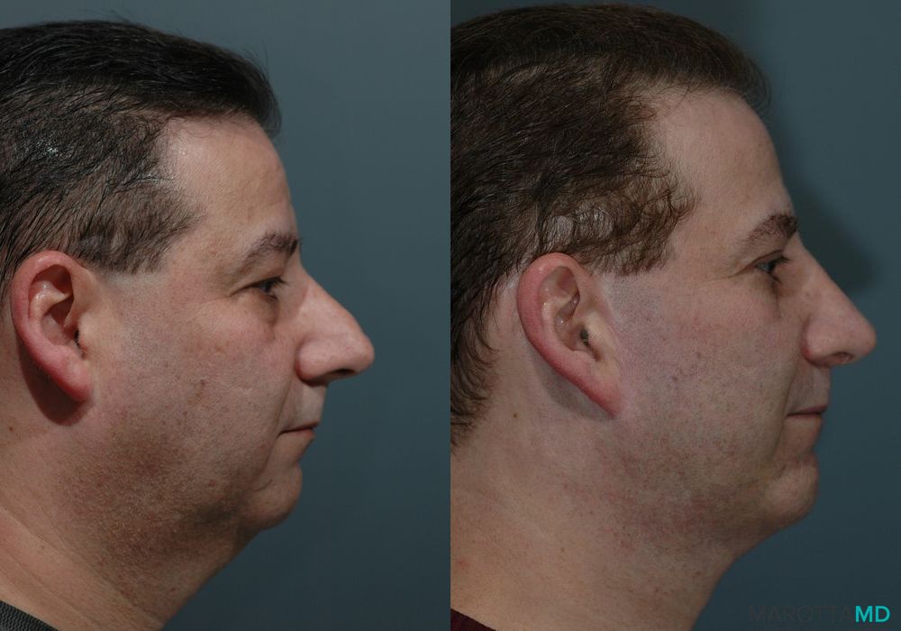 Blepharoplasty - Thumbnail 3