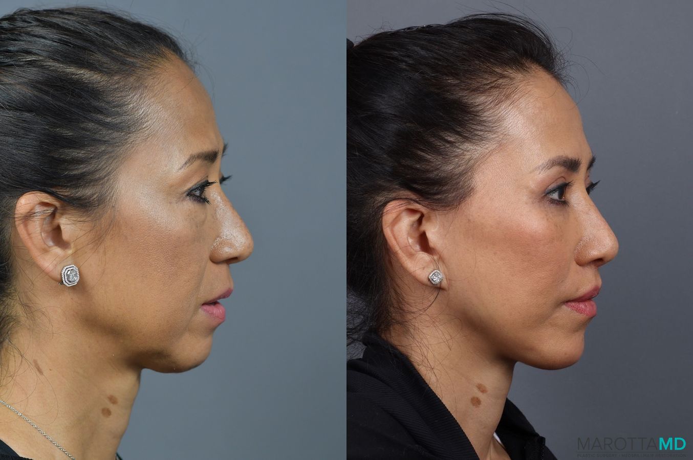 Before and after Blepharoplasty case 7025 - Angle 3