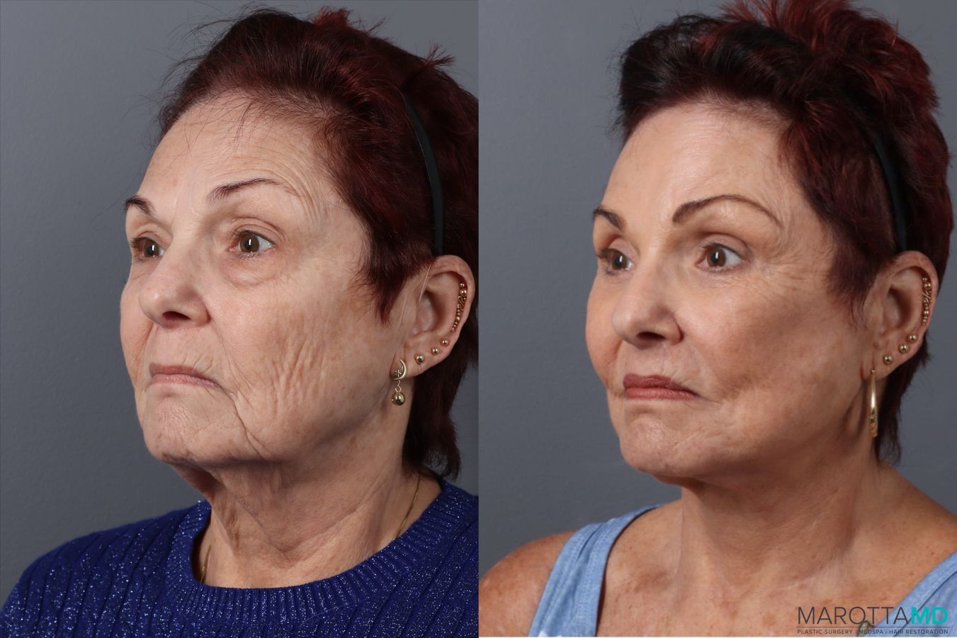 Before and after Blepharoplasty Lower case 49464 - Angle 4