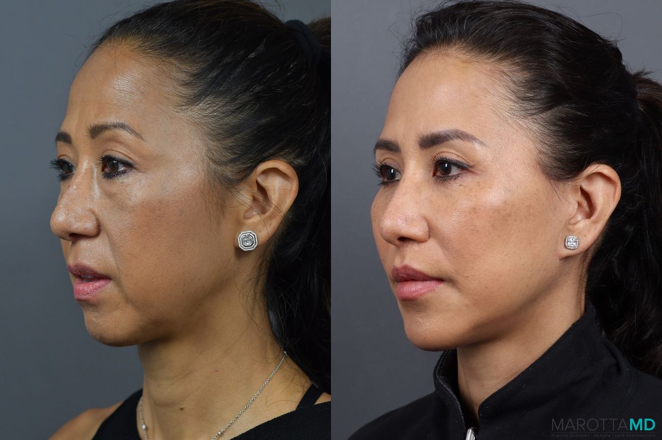 Before and after Blepharoplasty case 7025 - Angle 4