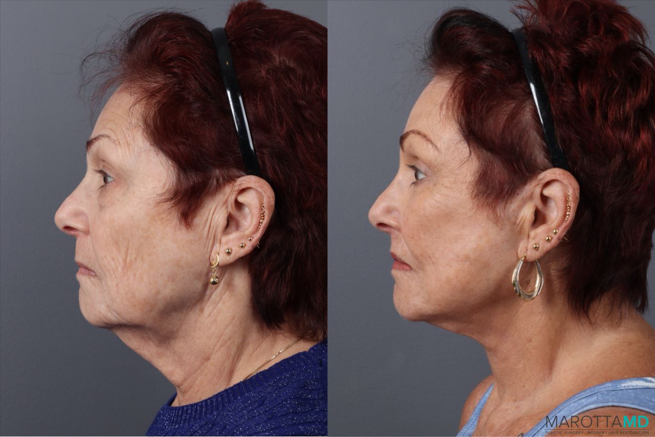 Before and after Blepharoplasty Lower case 49464 - Angle 5