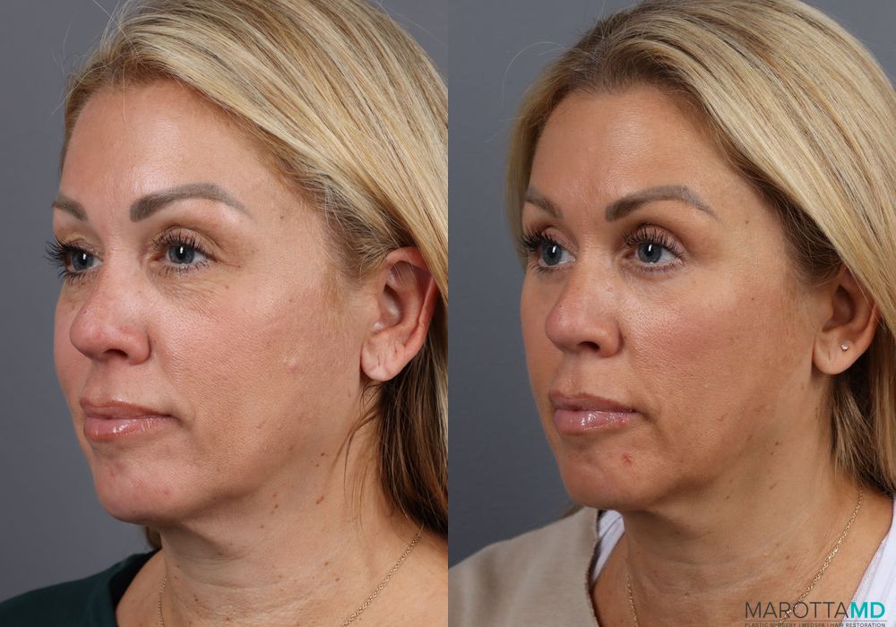 Blepharoplasty - Thumbnail 2