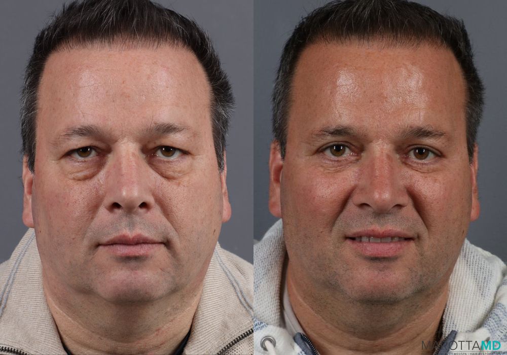 Blepharoplasty - Thumbnail 2