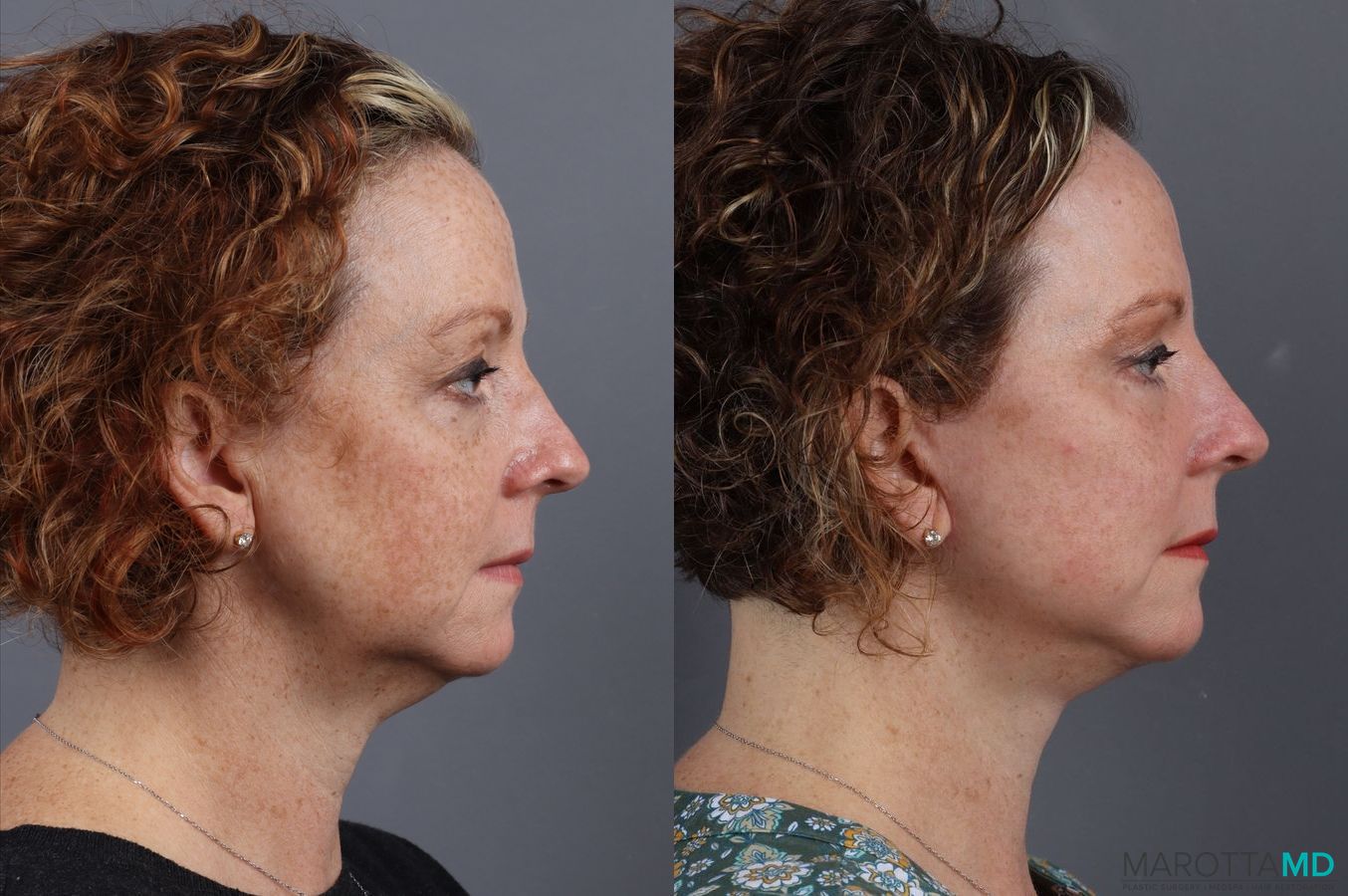 Before and after Blepharoplasty case 7084 - Angle 5